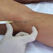 Tratamento-de-varizes-com-espuma